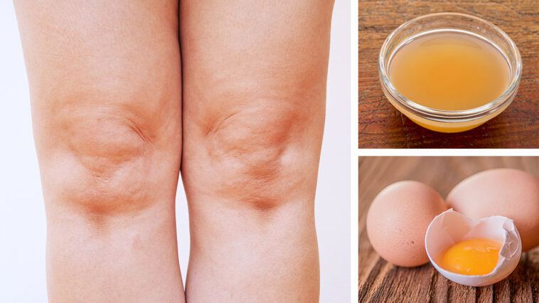 Which protein causes joint pain?