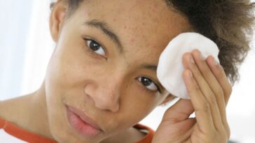 Why do potatoes cause acne?