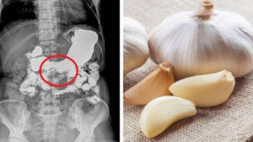 Why do raw onions hurt my stomach?