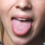 Why does ketchup make my tongue burn?