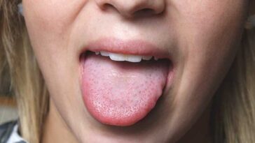 Why does ketchup make my tongue burn?