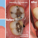 Why does my tooth feel loose when I bite it?