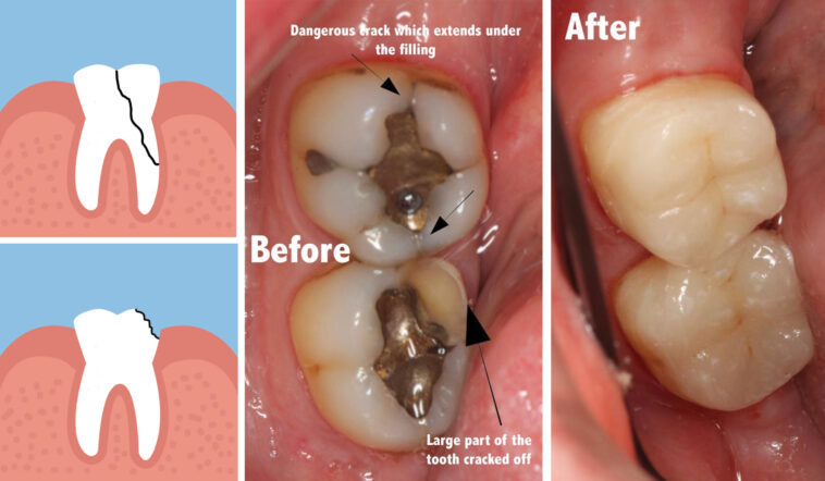 Why does my tooth feel loose when I bite it?