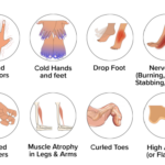 Why is it called Charcot-Marie-Tooth disease?