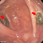 Why is it hard to poop after eating popcorn?