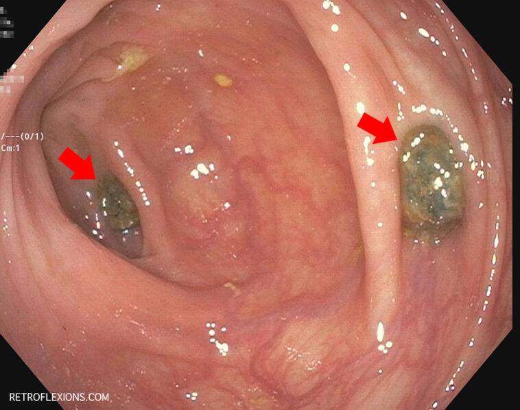 Why is it hard to poop after eating popcorn?