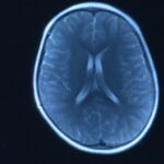 Will brain fog from Covid go away?