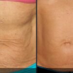 Will losing 50 pounds cause loose skin?