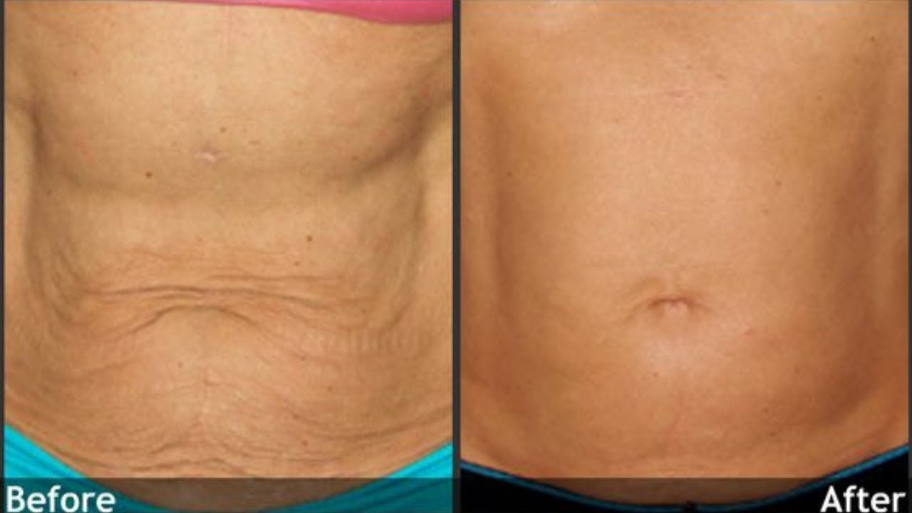 How do you keep skin tight while losing weight?