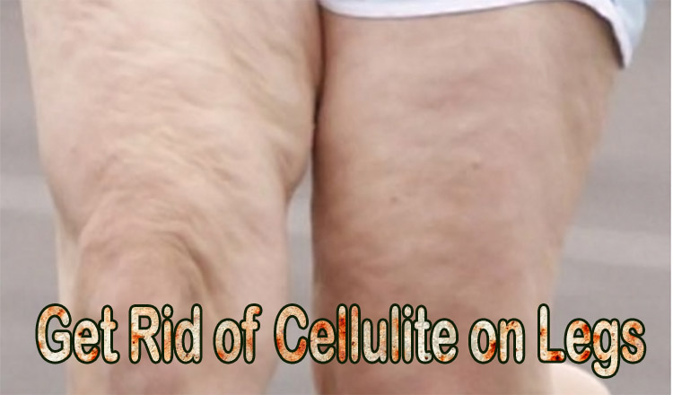 Will running get rid of cellulite on legs?