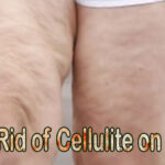 Will running get rid of cellulite on legs?