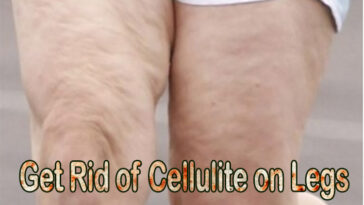 Will running get rid of cellulite on legs?