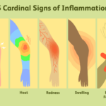 What are the 5 classic signs of inflammation?