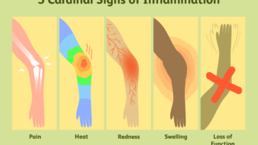 What are the 5 classic signs of inflammation?