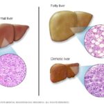 What are the first signs of liver damage from alcohol?