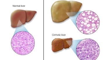 What are the first signs of liver damage from alcohol?