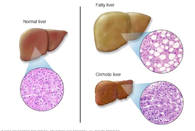 What are the first signs of liver damage from alcohol?