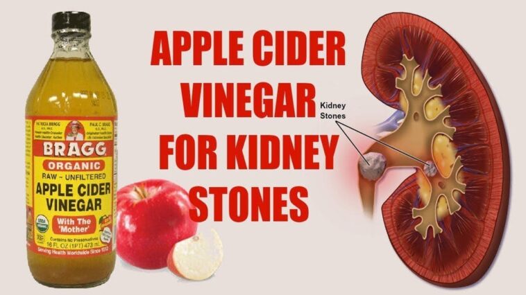 What dissolves kidney stones fast?