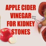 What dissolves kidney stones fast?
