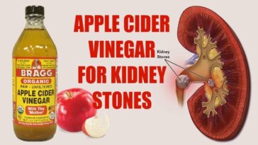 What dissolves kidney stones fast?