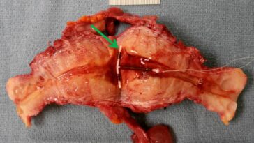 What does mugwort do to the uterus?