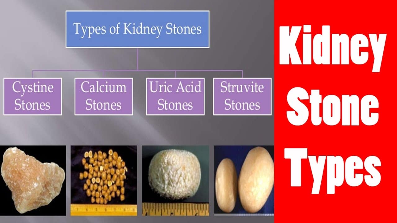 does black tea cause kidney stones Archives Foodly Magazine 1 Food & Gastronomie Recettes