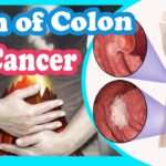 What was your first colon cancer symptom?