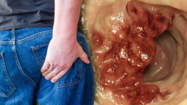 Where is colon cancer pain felt?